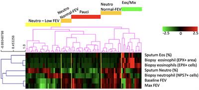 Neutrophilic Asthma Is Associated With Smoking, High Numbers of IRF5+, and Low Numbers of IL10+ Macrophages